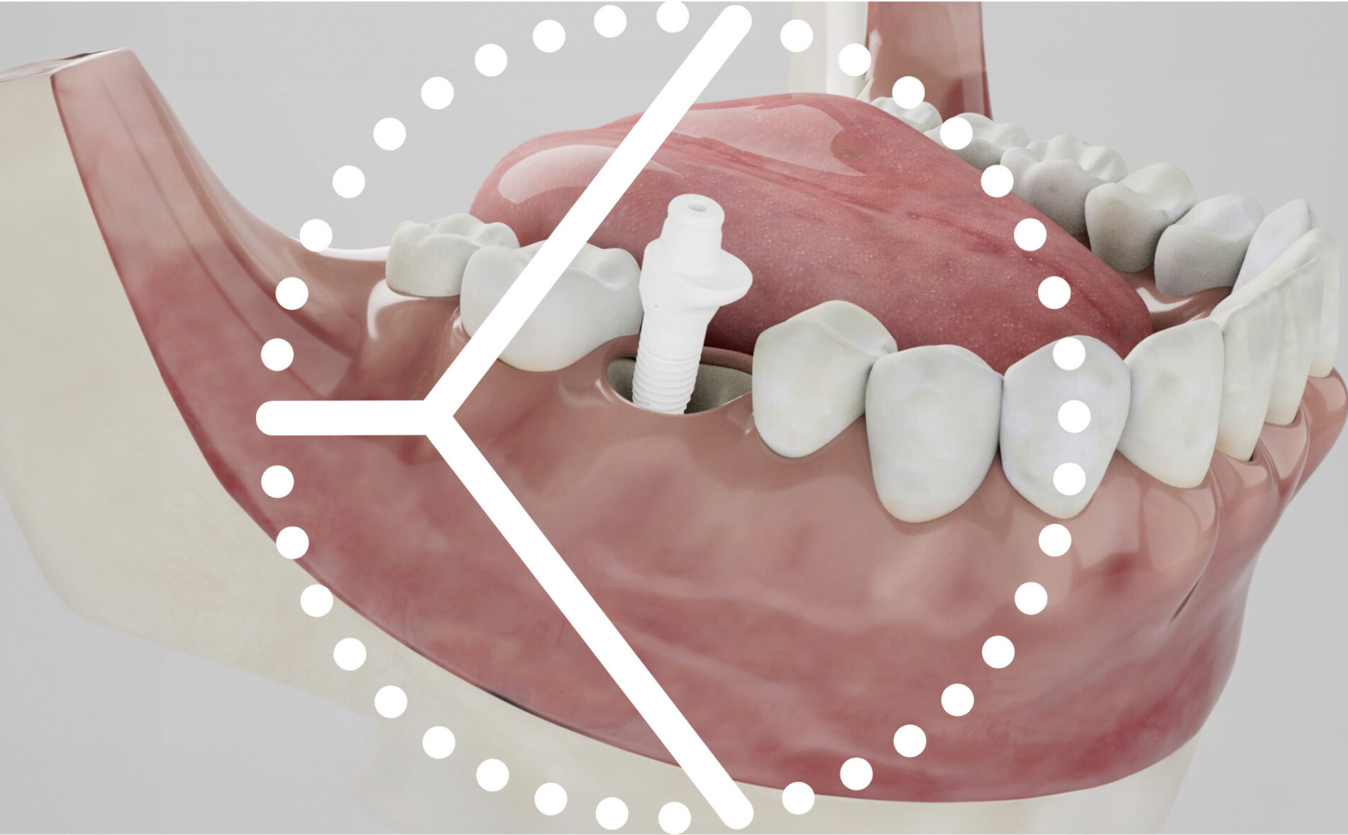 kotschy mikroskop lupe keramikimplantate